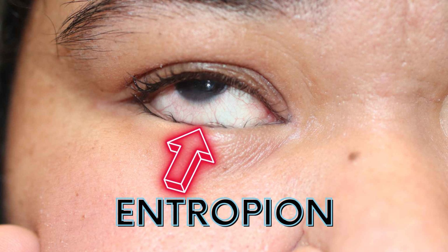 Entropion,